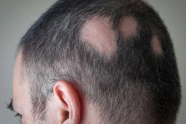 alopecia-localizzata